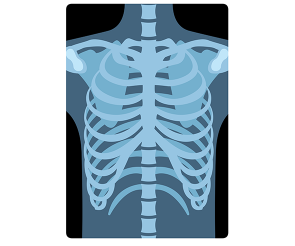 갈비뼈 엑스레이 사진