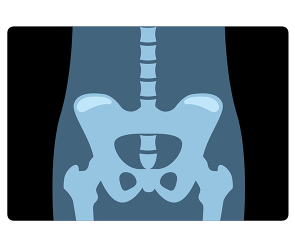 골반 엑스레이 사진