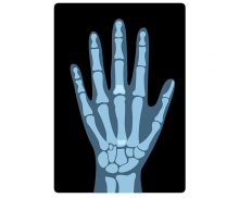 손 엑스레이 사진