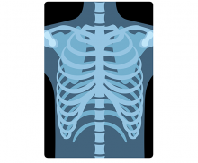 갈비뼈 엑스레이 사진