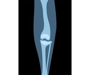 동물 다리 엑스레이 사진